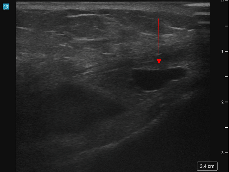 Case 65: Knee Pain - UCSD Ultrasound